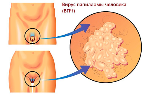 Аногенитальный кондиломатоз